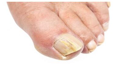 athlete's foot and nail